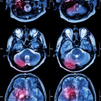 Shining a light on the brain