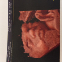 MEDCAST 4 - AMNIORREXIS PREMATURA