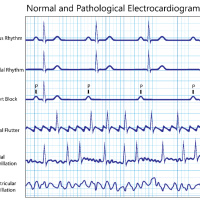 (110) Anticoagulação na FA valvular vs não valvular