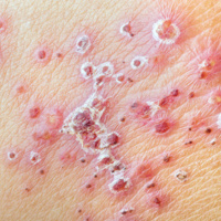 (152) Vacina contra o Herpes Zoster (Zona)