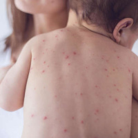 Até o início dessa semana, foram confirmados 1.673 casos de sarampo em todo o país