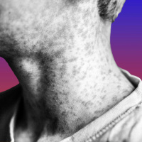 A Measles Outbreak and Wake-Up Call