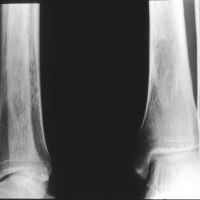 Podcast Episode #63: What You Don’t Know About Bone Density