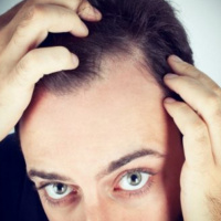 Hair Loss: Looking beyond Genetics