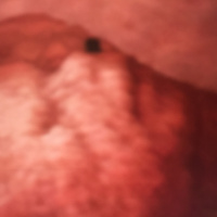 MEDCAST 5 - DISMENORREIA