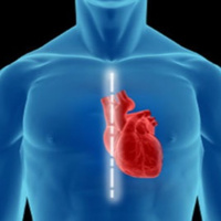 Prevenção do delírio pós cirurgia cardíaca