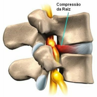 Uso de corticóides epidural