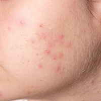 Healing Acne - Radio Show Archive