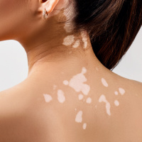 Healing Vitiligo - Radio Show Archive