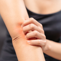 Healing Eczema, Psoriasis,  Acne - Radio Show Archive