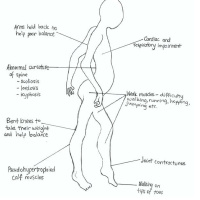 Genecast #021 - Duchenne