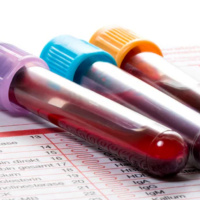 Tireoglobulina elevada é preocupante?