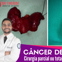 Câncer de tireóide - cirurgia parcial ou total? - Dr Tireóide responde #119#