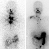 Radioiodoterapia e o câncer de tireóide