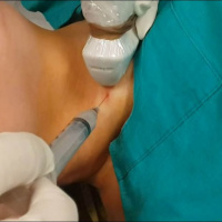 Motivos para puncionar um nódulo na tireóide