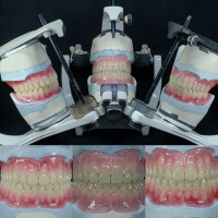 Episódio 73 - Escultura de Gengiva de Acordo com a Morfologia Dental com Angelo Rossett