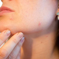 Ondas da Ciência 221 - Nova tecnologia para tratar a acne